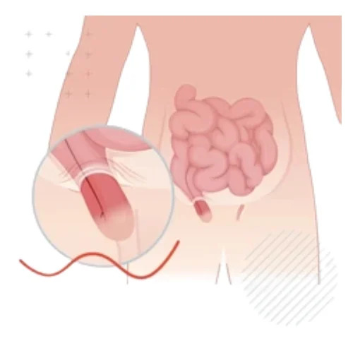 Recurrent Hernia