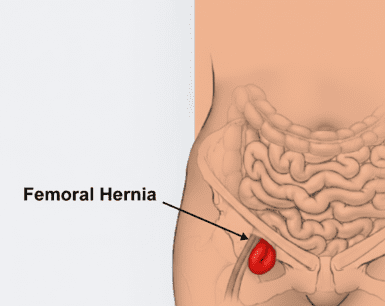 Femoral Hernia