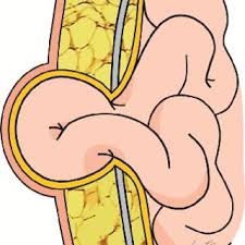 Incisional Hernia