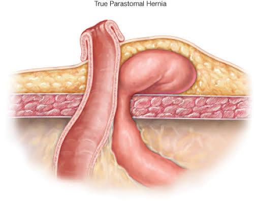 Parastomal Hernia